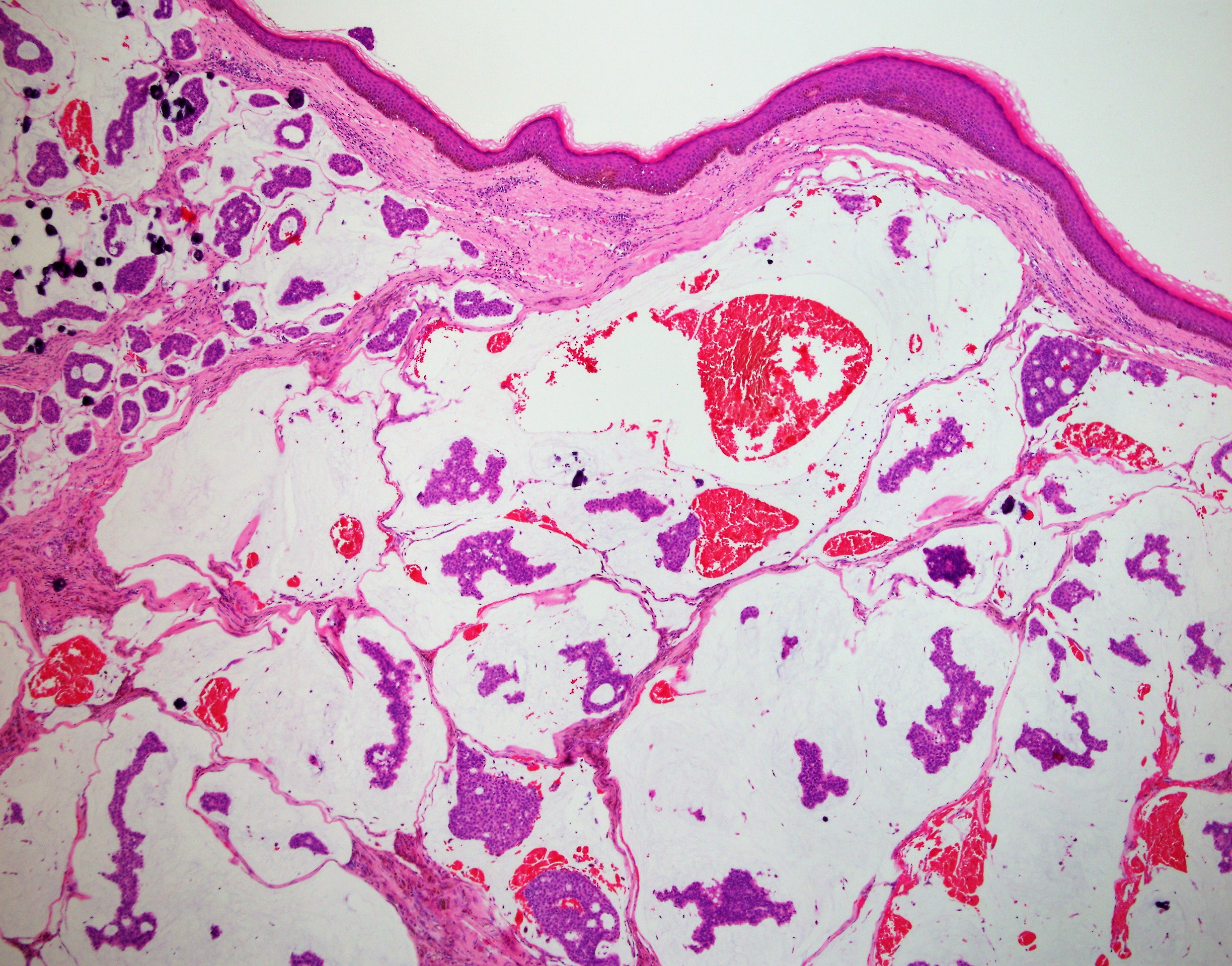 Primary Cutaneous Mucinous Carcinoma | Global Pathology Teaching And ...